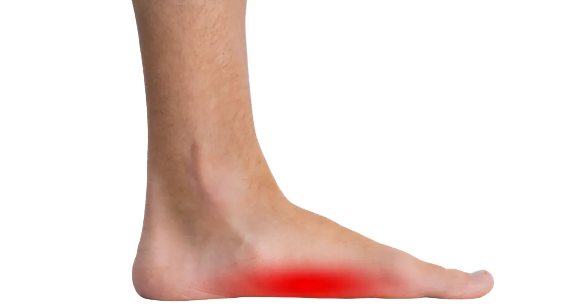 Doorgezakte voet | platvoet voorkomen