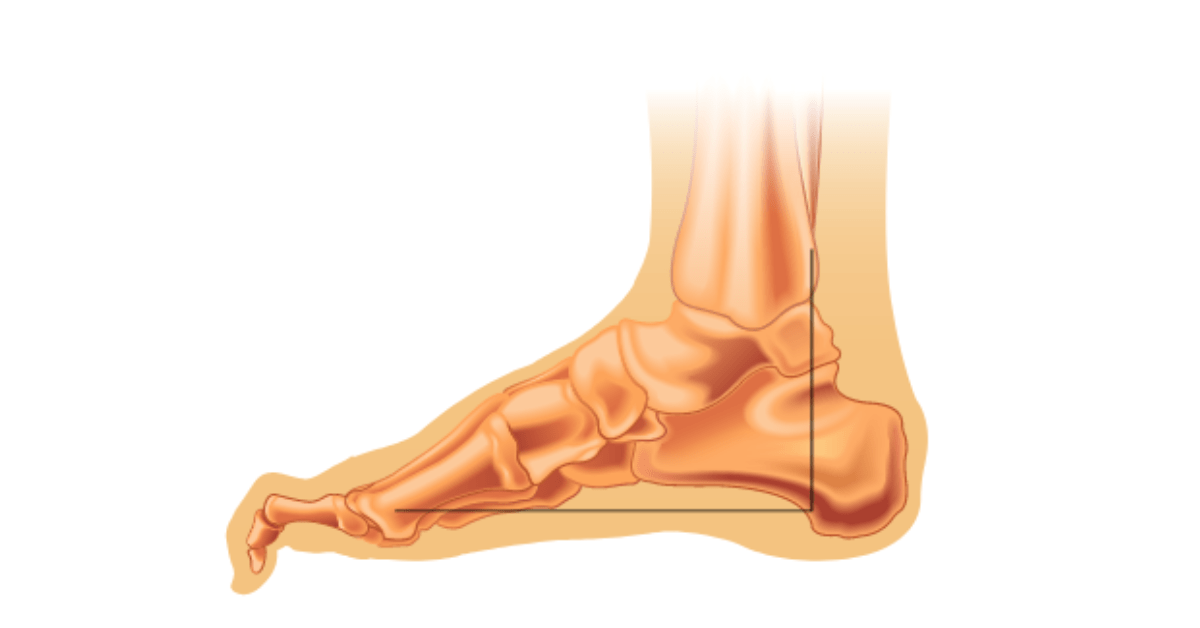 Hamertenen: Pijnlijk maar behandelbaar