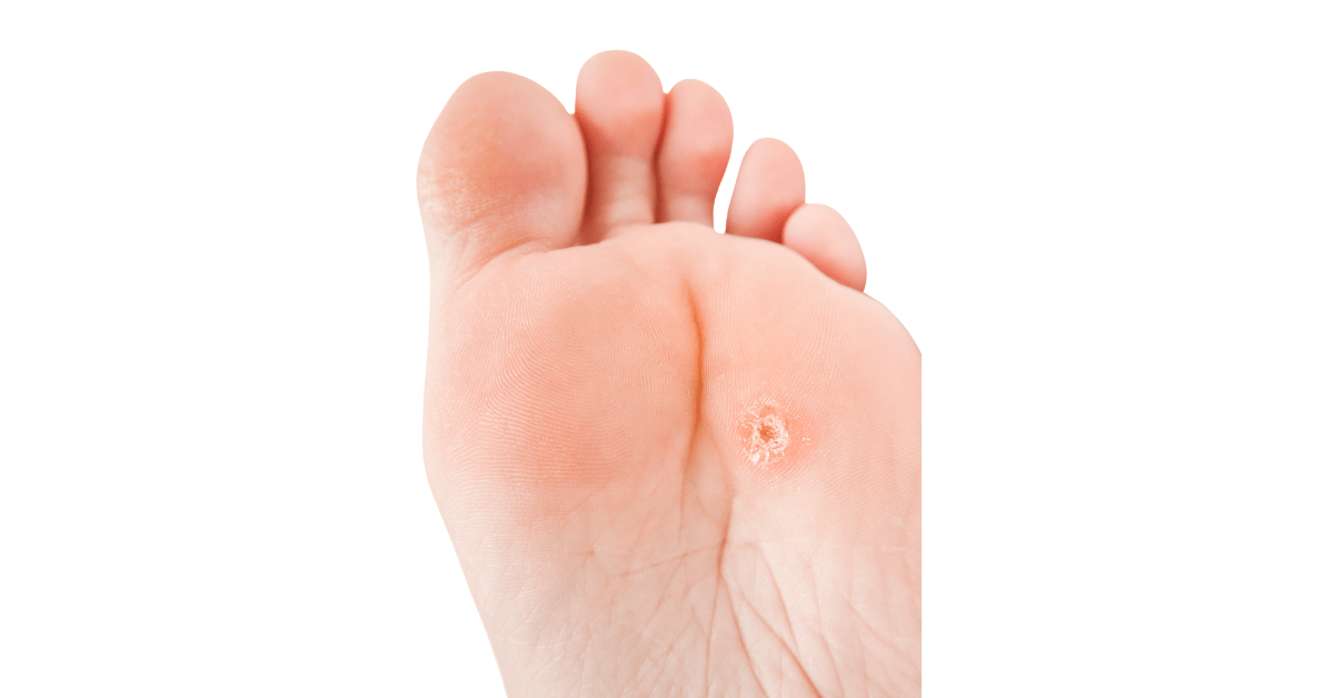 Likdoorn verwijderen behandelen en voorkomen