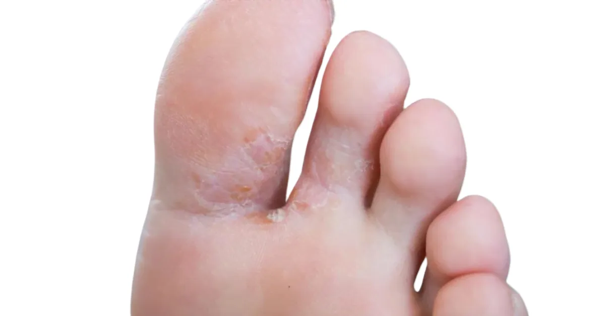 Voetschimmel (Tinea Pedis): Symptomen en behandeling