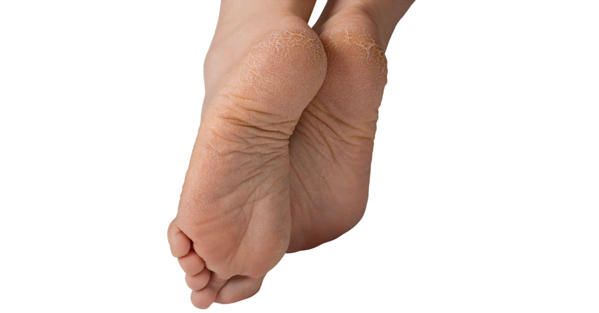 Praskliny na patách suchá kůže