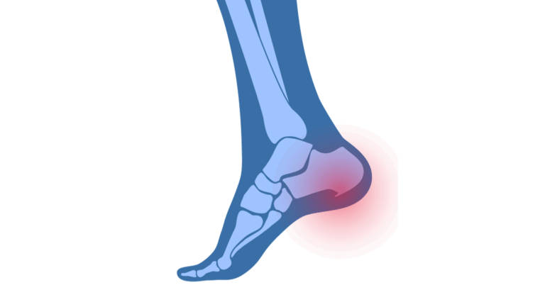 Patní ostruha-1200x628-1